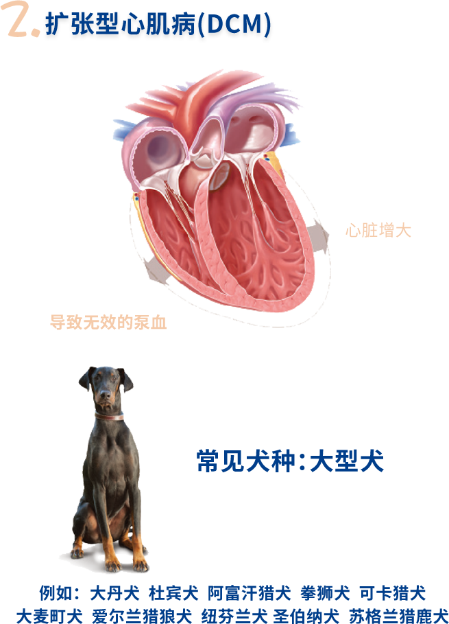 认识常见的心脏病 扩张型心肌病
